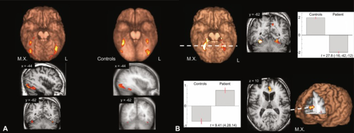 brain scan of MX experiencing hypoactivation of anterior cingulate gyrus